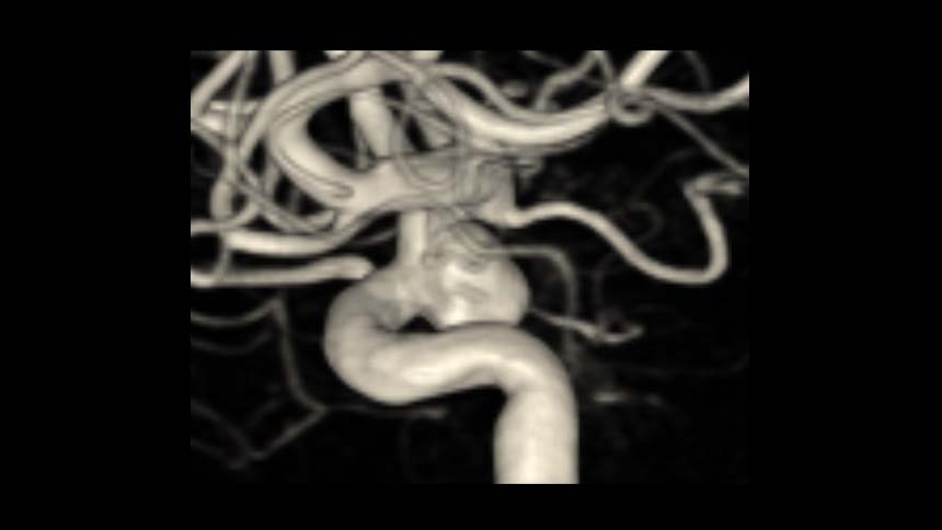 Man Feels “Lucky” Brain Aneurysm was Found and Treated Without it Rupturing
