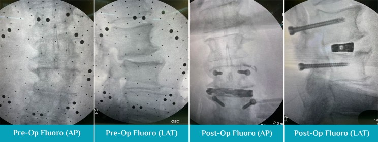 Progression of pre and post-op CAT scans.